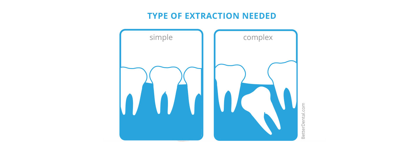 Extraction | Better Dental
