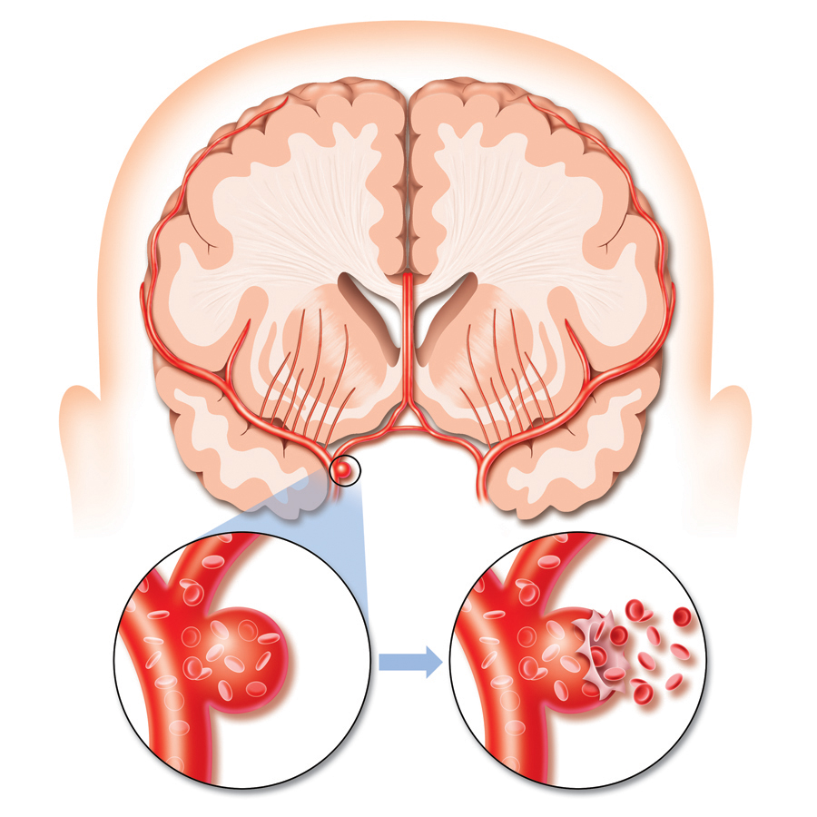 Images For > Stroke Clipart