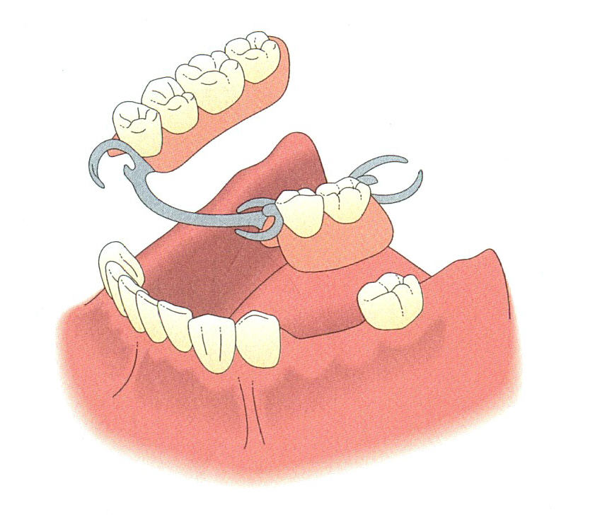 Dentures - Dentistry for Smiles, Dr. Sung-Oh Kim, Prosthodontist ...