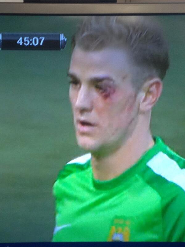 Ouch! Man City's Joe Hart got a bloodied eye after a nasty clash ...