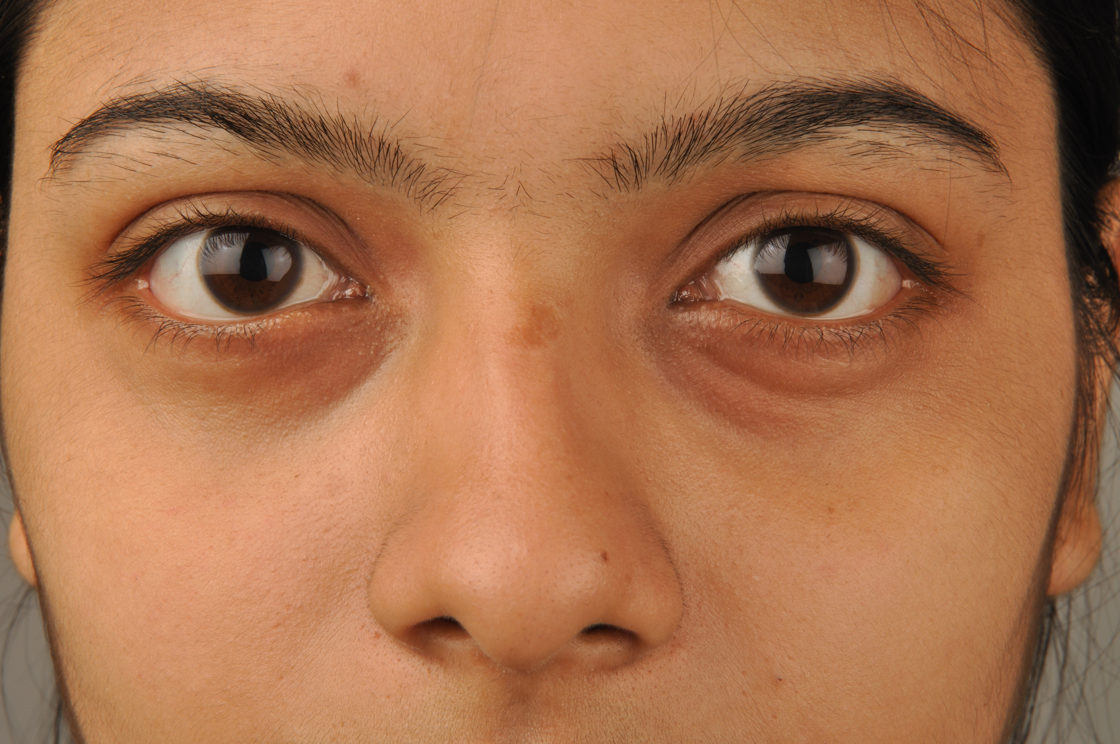 Several Factors Can Cause Dark Circles Under The Eyes ...