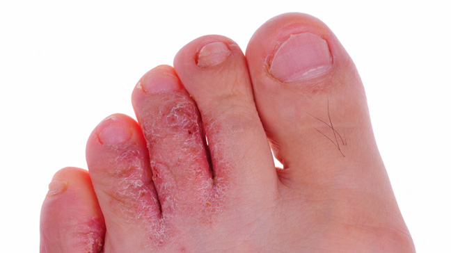 Athlete's Foot: Causes, Symptoms & Diagnosis