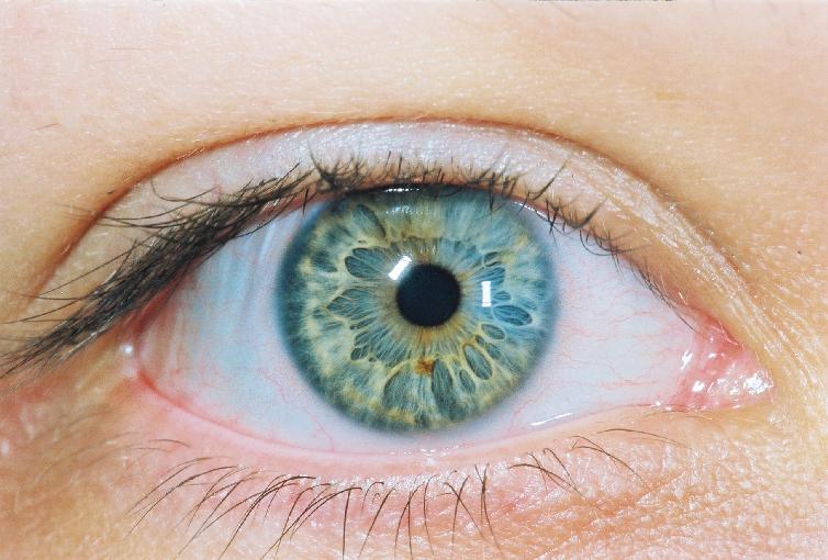 Jalene's Beautiful Heterochromic Eyes