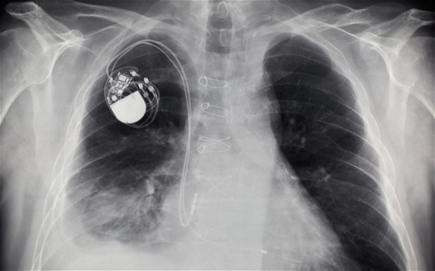 New pacemaker that imitates real heart could transform patients ...