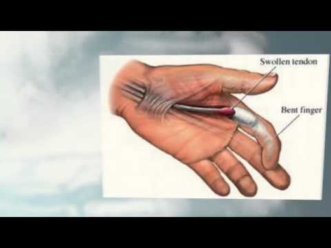 Index Finger Pain - Understanding Hand Pain - YouTube